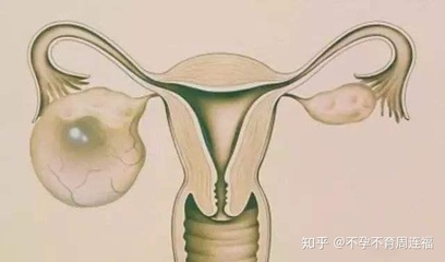 卵巢囊肿还能怀孕吗