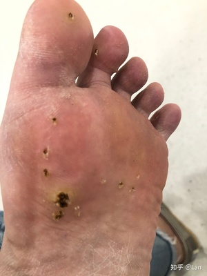 脚上长疣怎么治疗
