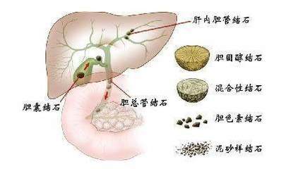 胆结石怎么治疗效果好