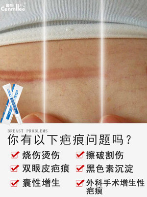 烫烧膏擦痘痘管用吗