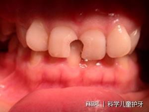 蛀牙酸疼是什么情况