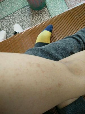 背部为什么好多痘痘