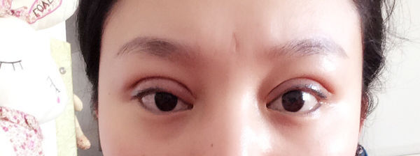 做完双眼皮一只眼睛肿