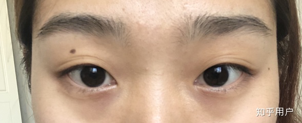 为什么眼皮很松