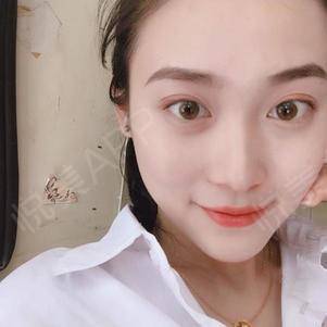 开眼角拆线后多久化妆