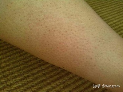 皮肤鱼鳞病怎么治疗