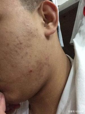闭口痘痘长什么样子
