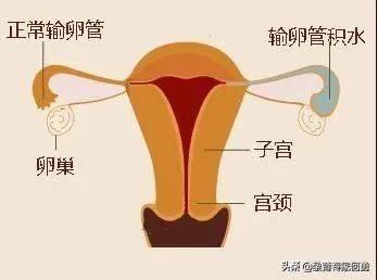 输卵管扩张是怎么回事