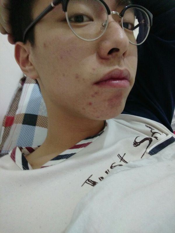 男生额头老是长痘痘