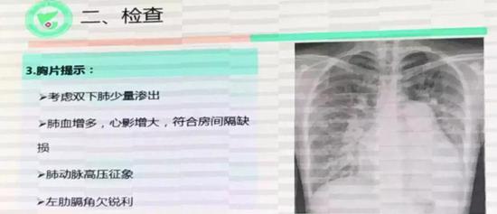 心脏影增大是怎么回事