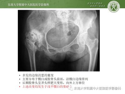 股骨头囊变是怎么回事