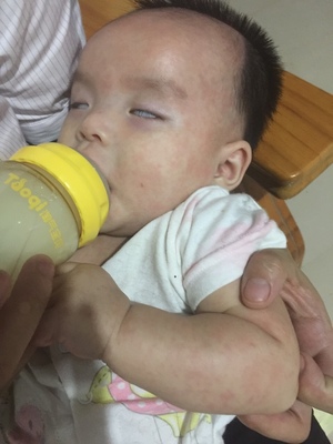 宝宝低烧反复