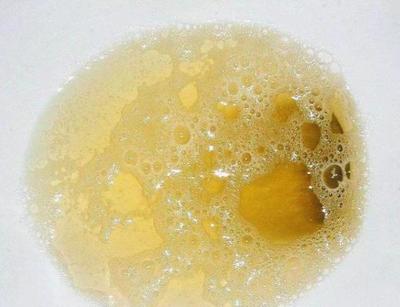 小便有白色泡沫是怎么回事