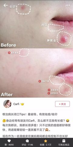 满脸痘痘可以用祛痘面膜嘛