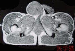 乳糜尿怎么检查