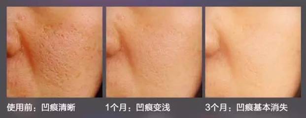 美容能去痘印吗