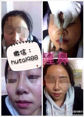 祛斑针需要注意什么
