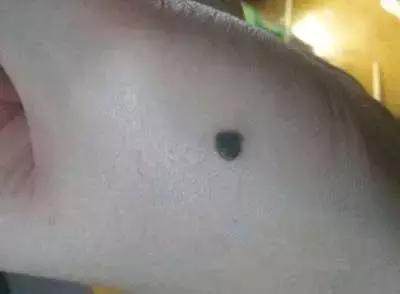 新生儿长痣