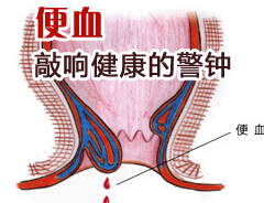 痔疮怎么治疗效果好