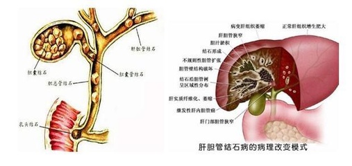 胆管结石怎么治疗好