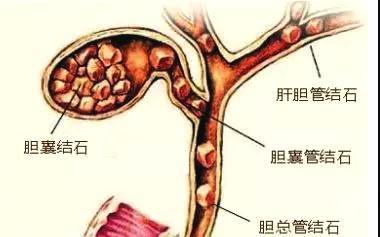 胆结石该怎么治疗