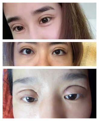 割双眼皮影响运气吗