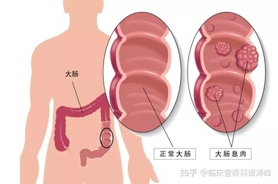 直肠腺瘤怎么治疗方法