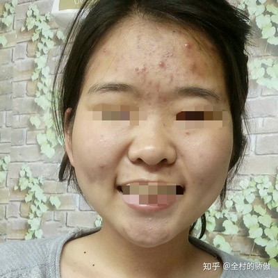 脸部起痤疮如何治