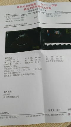 胎儿绕颈三周