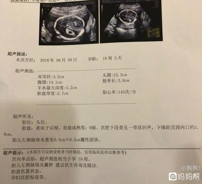 胎儿左侧脉络丛囊肿