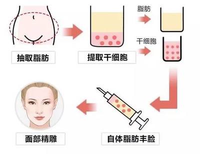 线雕隆鼻和玻尿酸区别