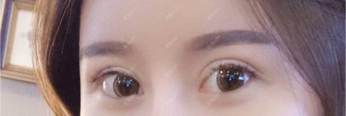 双眼皮做完一个月还肿