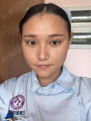 激光点痣多久可以化妆