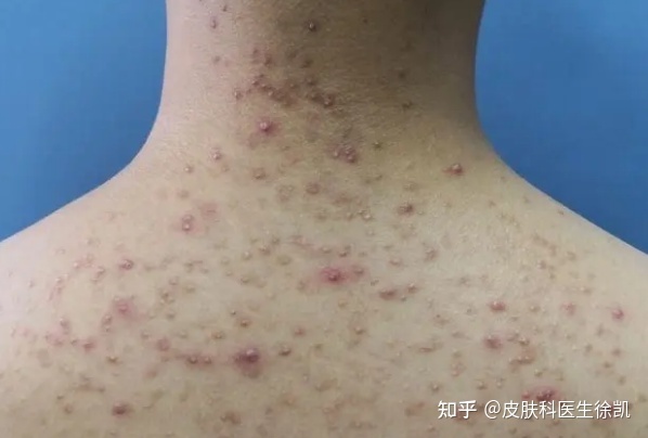 怎样消除疤痕疙瘩