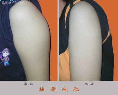 上臂吸脂减肥的价格