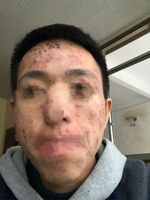 脸上痘痘红印怎么消除