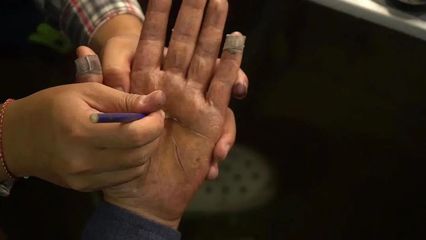 手掌疤痕