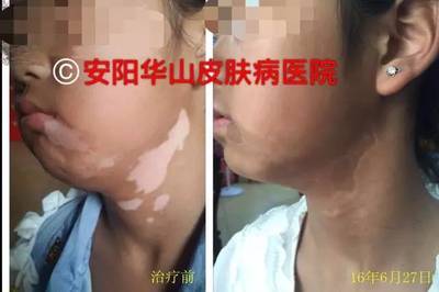 湿疹疤痕