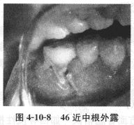 牙齿碰伤后还能愈合吗