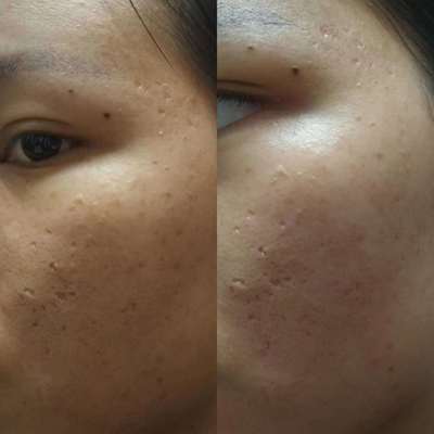 激光治痘痘后遗症