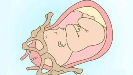 胎儿入盆的症状