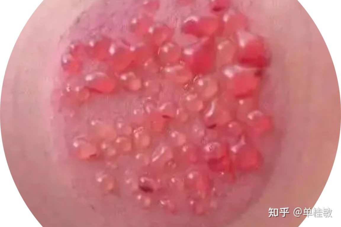 拔罐出泡是怎么回事