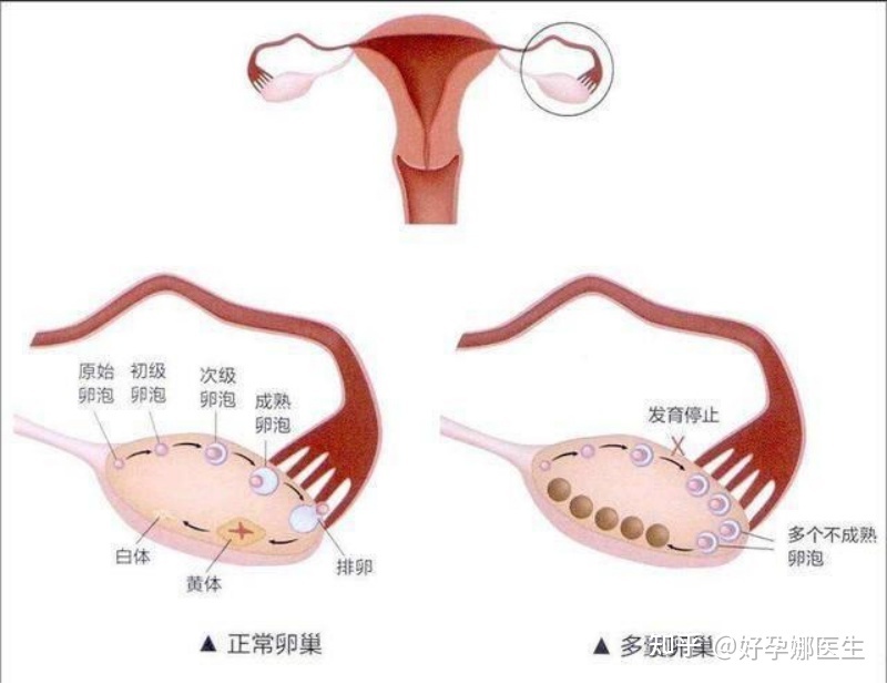 卵泡多怎么治疗