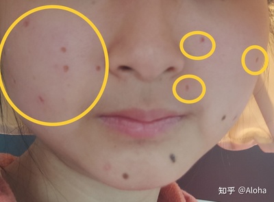 祛痣后的红印怎样消除