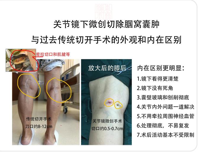 膝关节滑囊炎怎么治疗
