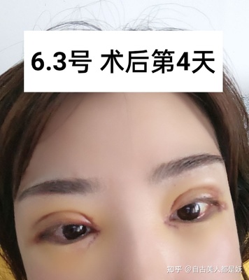 全切双眼皮拆线后注意事项