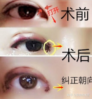 割完双眼皮想再开眼角