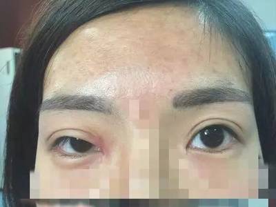 眼皮耷拉是什么病