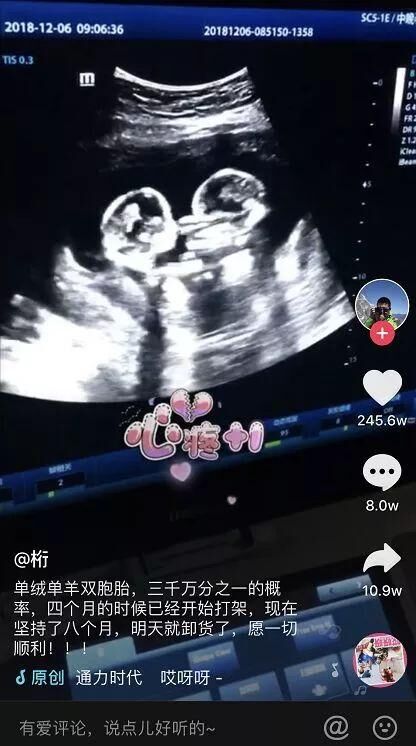 疤痕子宫可以怀双胞胎吗
