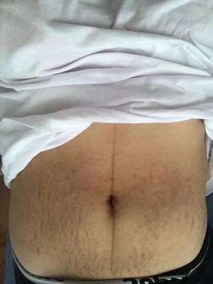 怀孕腰变粗